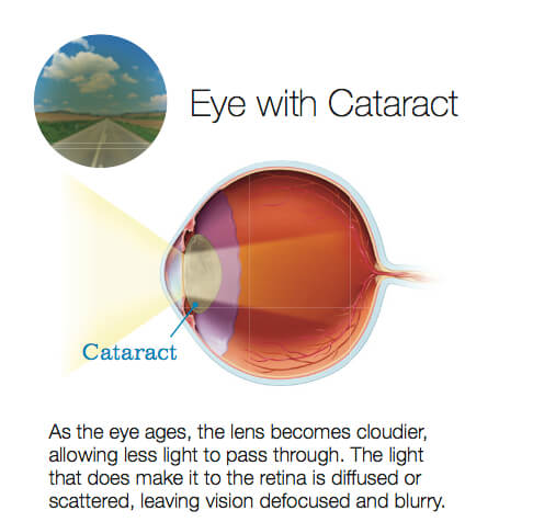 eye with cataract graphic