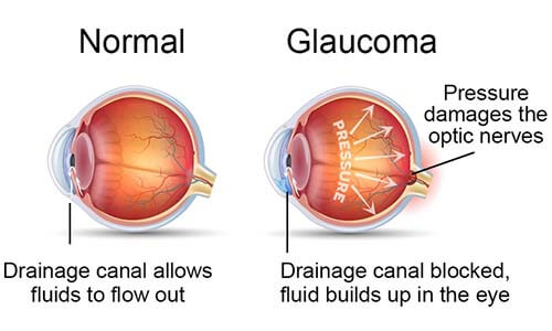 Chart Illustrating a Normal Eye Vs One With Glaucoma