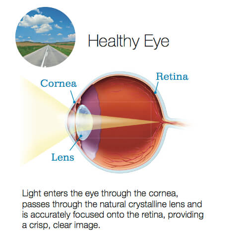 Healthy Eye diagram