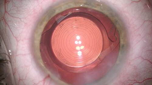 Closeup of a Multifocal Lens in an Eye