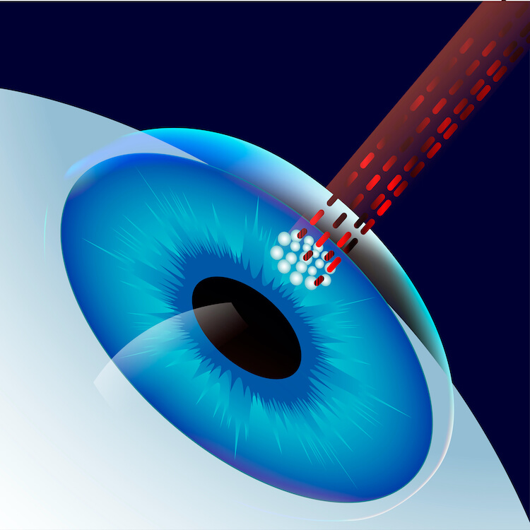 ASA eye surgery diagram