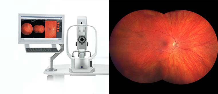 CLARUS Ultra-Widefield Retinal Camera