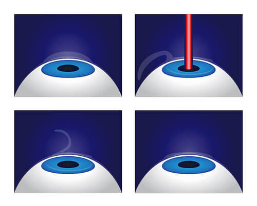 LASIK Procedure Diagram