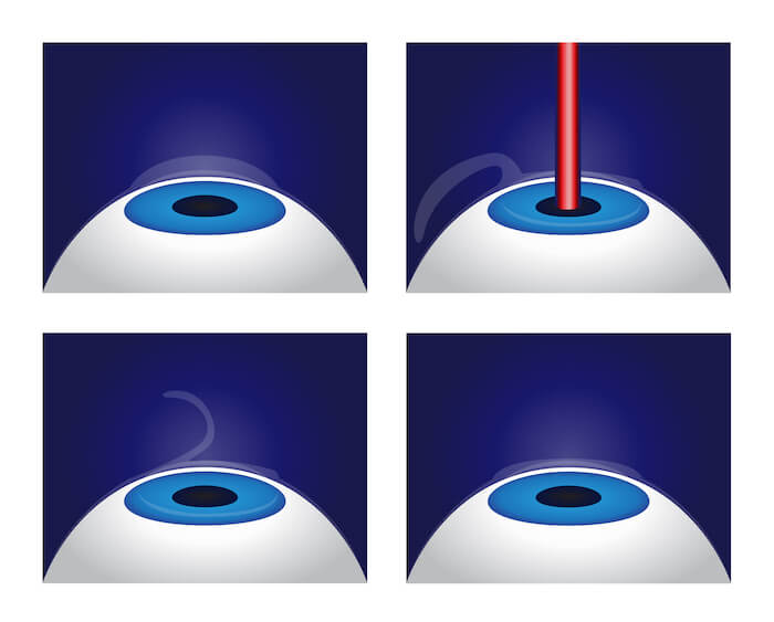 LASIK procedure diagram